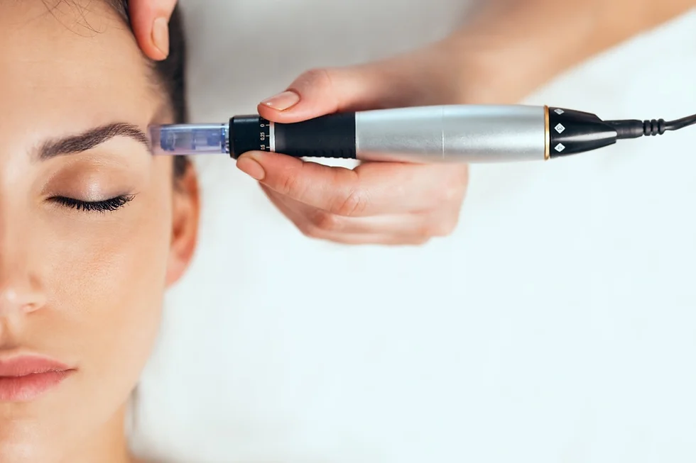 Μεσοθεραπεία λεύκανσης με dermapen