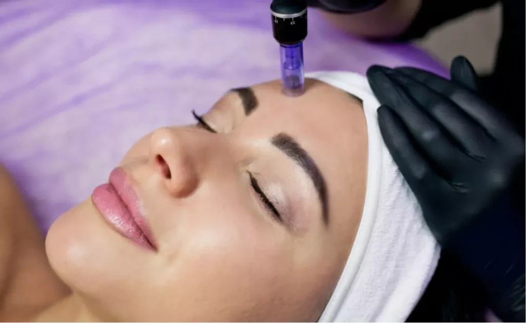 Μεσοθεραπεία με dermapen